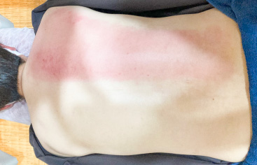 スライドカッピング