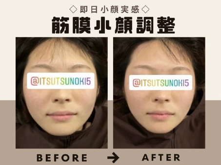 小顔矯正